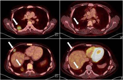 Case Report: Multifocal EBV-Associated Diffuse Large B-Cell Lymphoma in a Patient With 6-MP Associated Lymphopenia With TPMT Deficiency